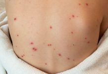 तेजी से फैल रहा Tomato Fever, जानें क्या हैं लक्षण? इन लोगों को है खतरा