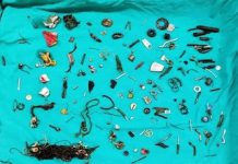 ऑपरेशन के दौरान व्यक्ति के पेट से निकले लोहे के कई समान, डॉक्टर भी हुए हैरान